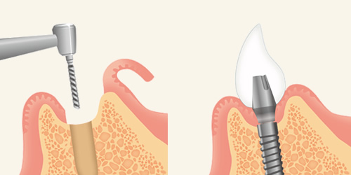 インプラント・義歯