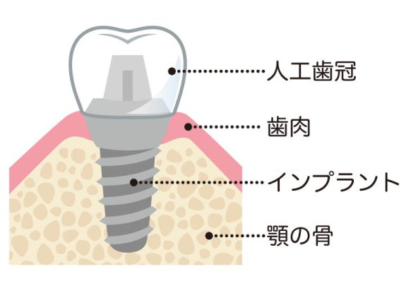 インプラントの構造