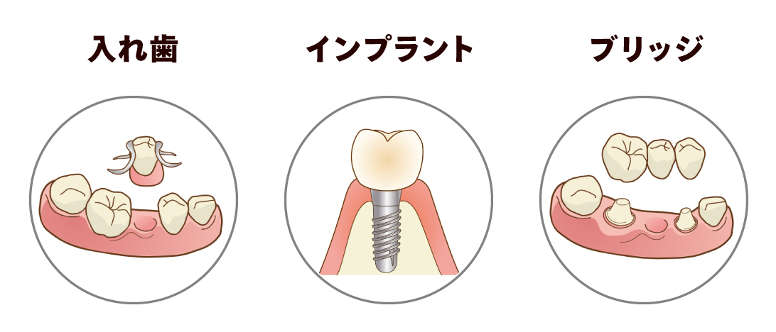 インプラントと他の治療法