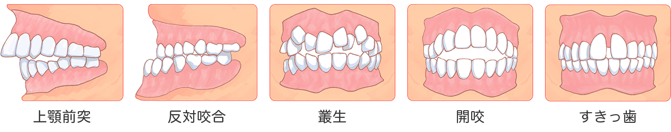 不正歯列