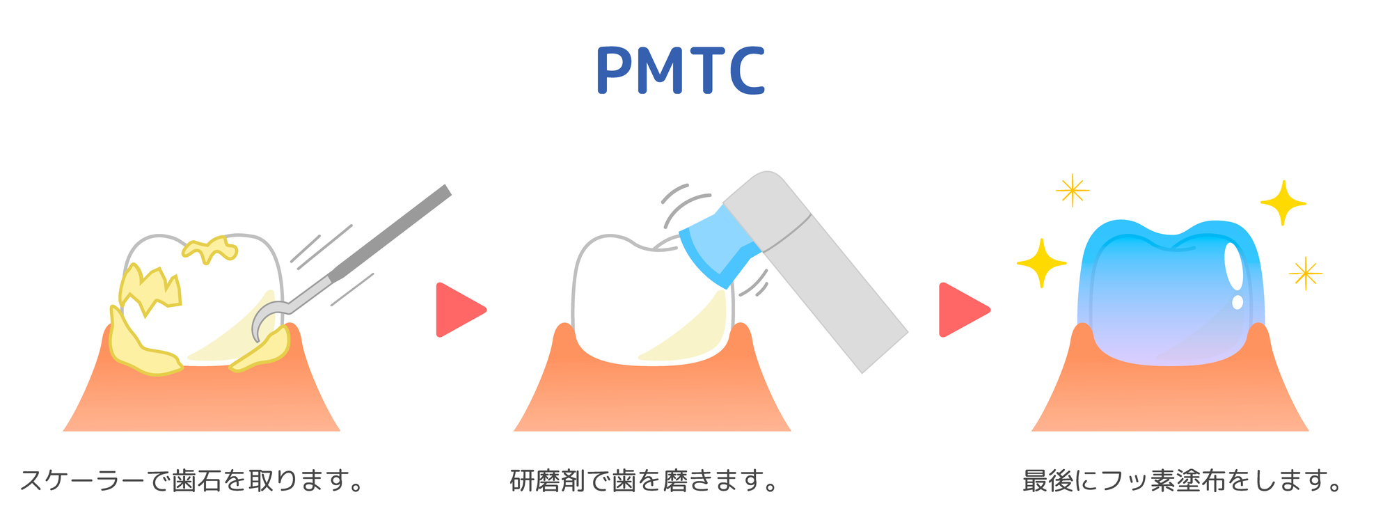 歯のクリーニングの流れ
